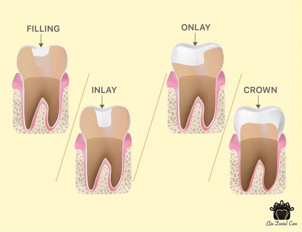Fillings VS Inlay/Onlay VS Crown Elite Dental Care Tracy