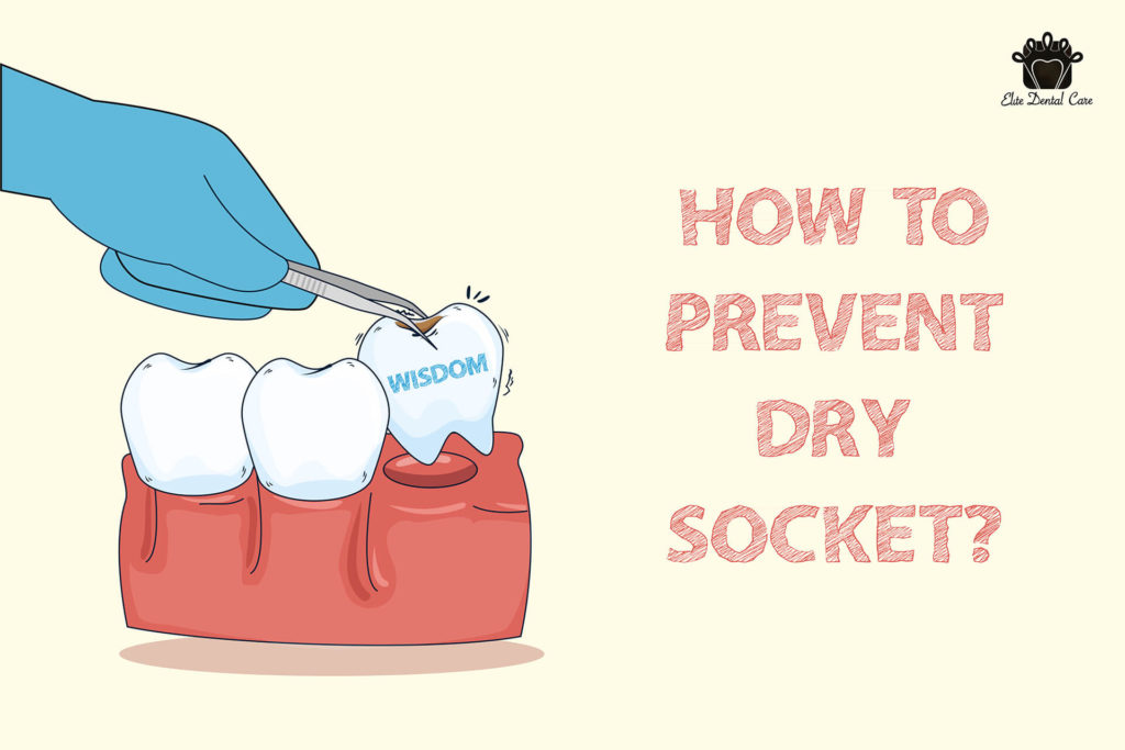 Can Gauze Prevent Dry Socket at Susan Marks blog