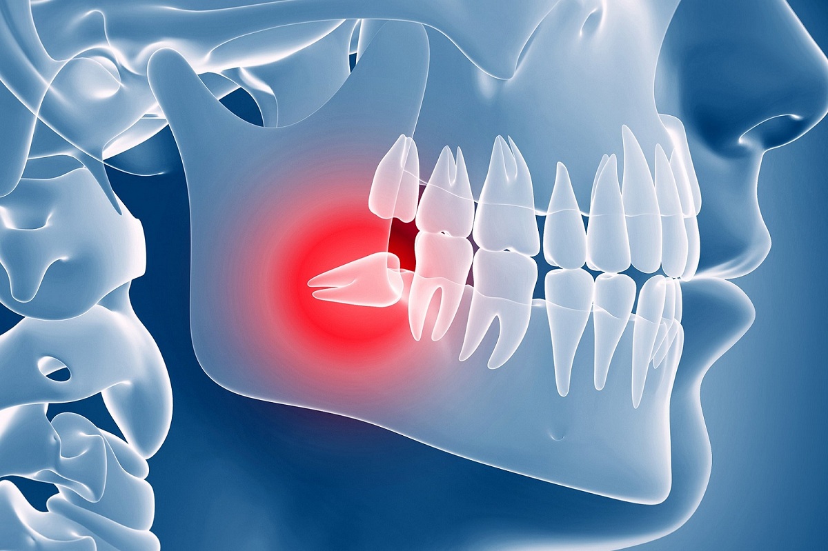 Wisdom Teeth Removal 5 Awesome Tips For Recovery