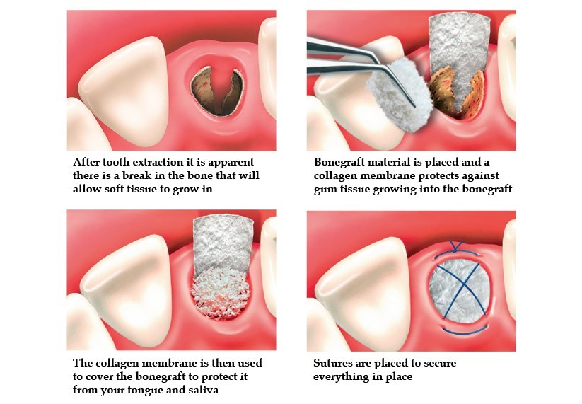Dental Bone grafting